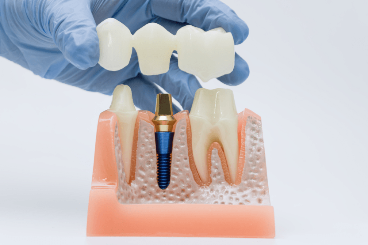 Implantología Oral